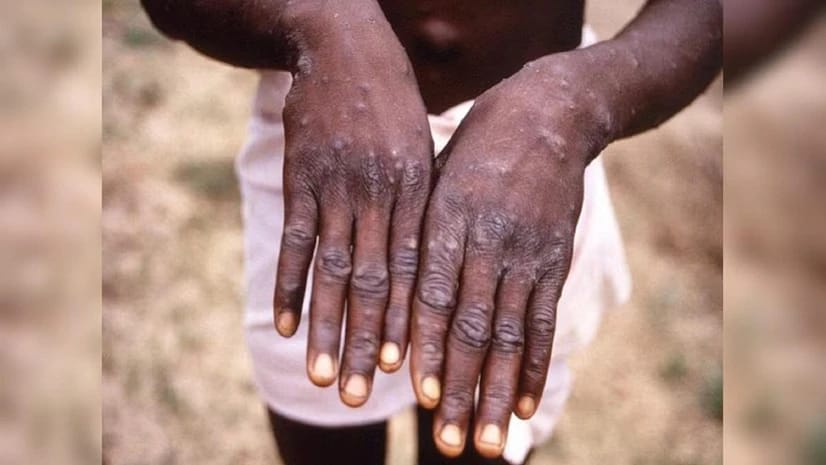 Centrafrique : deux cas confirmés de Mpox recensés dans le sud-ouest du pays